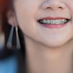 Todo lo que necesitas saber sobre la ortodoncia