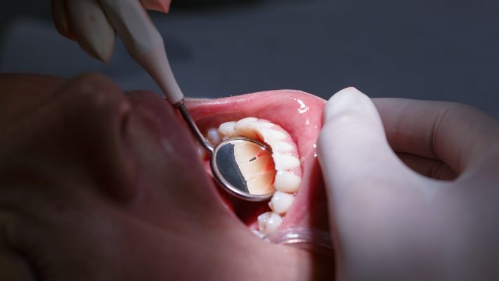 Tratamientos claves en estética dental